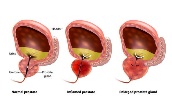 prostatit är en inflammation i prostatakörteln