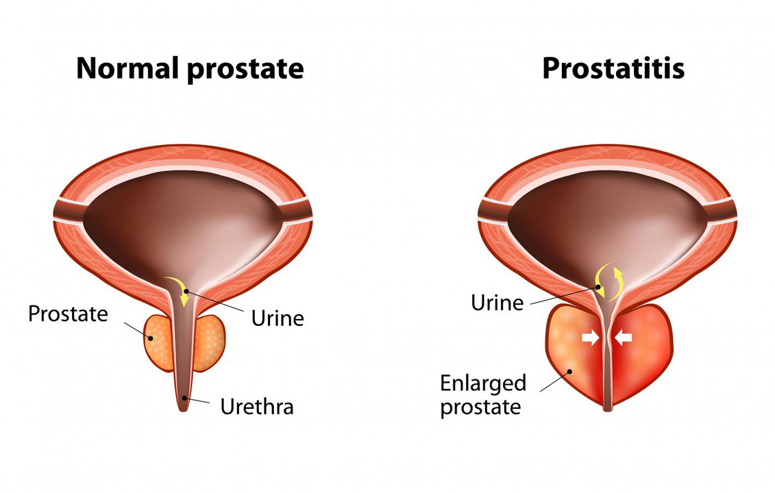 Normal prostata hos en frisk man och inflammation i prostatakörteln med prostatit
